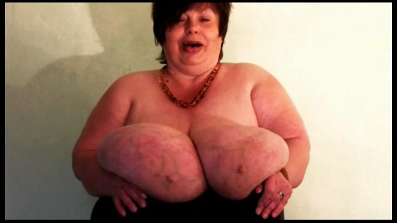 Karola Gigantomastia Large Breasts